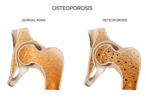 Homecare Kirkland WA - National Osteoporosis Prevention Month: Five Foods Mom Needs to Eat for Strong Bones